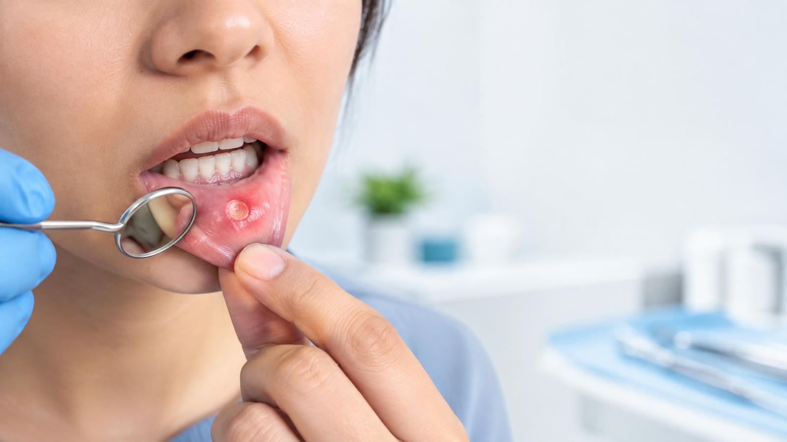 Mouth Ulcer Treatment in Chandkheda